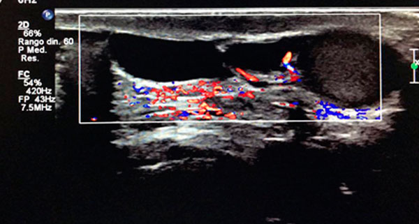 Se observa una imagen hipoecogénica, avascular, dentro de la bolsa escrotal derecha, que mide 3 x 2mm.