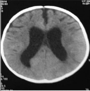 Figura 1. TAC de la paciente que muestra hidrocefalia