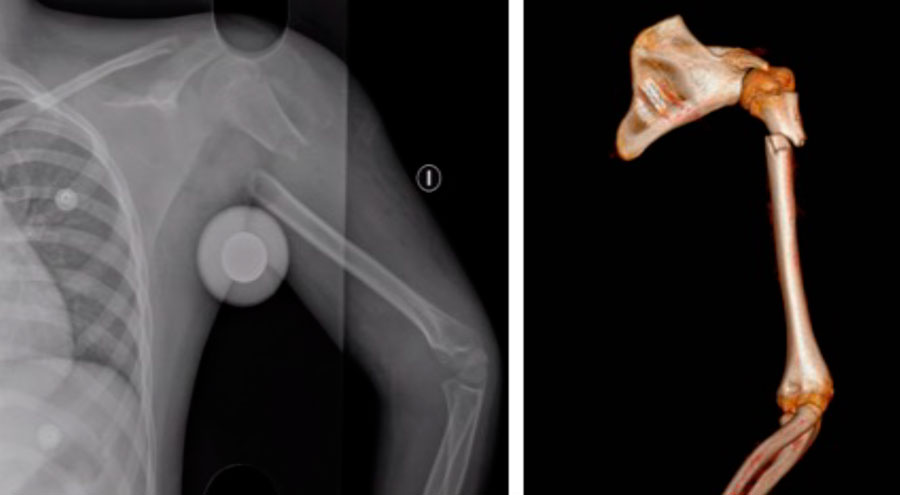 Figura 2. Radiografía anteroposterior y TAC 3D del brazo izquierdo
