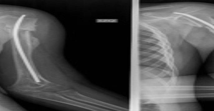 Figura 3. Radiografía anteroposterior y lateral del brazo izquierdo. Control post quirúrgico inmediato