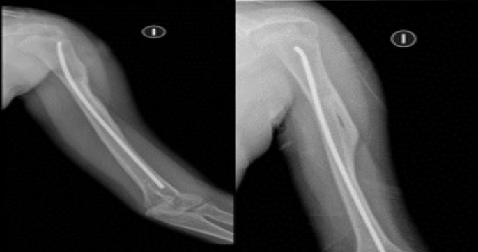 Figura 5. Radiografía anteroposterior y lateral del brazo izquierdo. Control post quirúrgico a los cinco meses