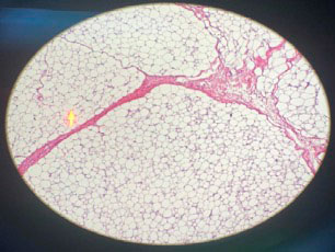 Figura 5. Vista microscópica, aumento X40. La flecha indica los adipocitos (Caso 1)