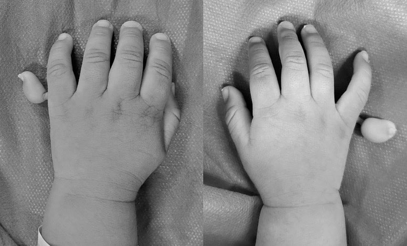 Figura 3. Polidactilia postaxial bilateral de ambas manos. Fuente: Hospital de niños “Dr. Roberto Gilbert Elizalde”
