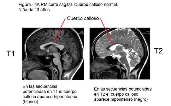 Diagnóstico por la imagen de la patología del cuerpo calloso en pediatría